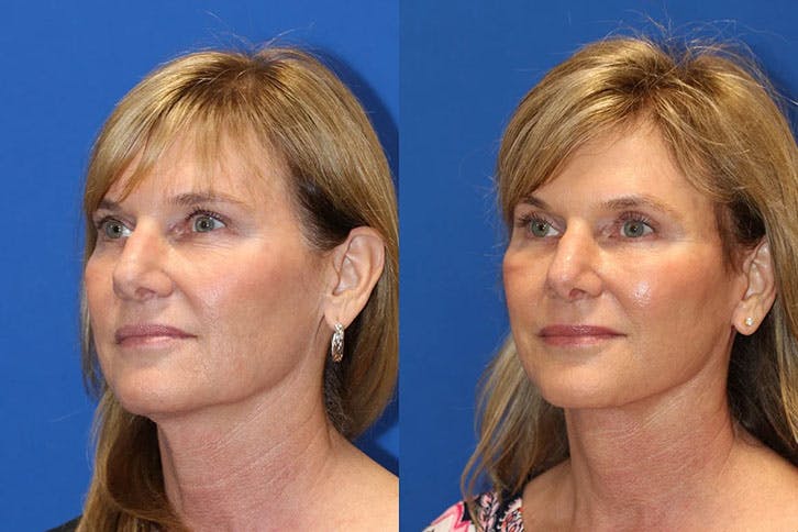 Laser Before & After Gallery - Patient 71701872 - Image 2