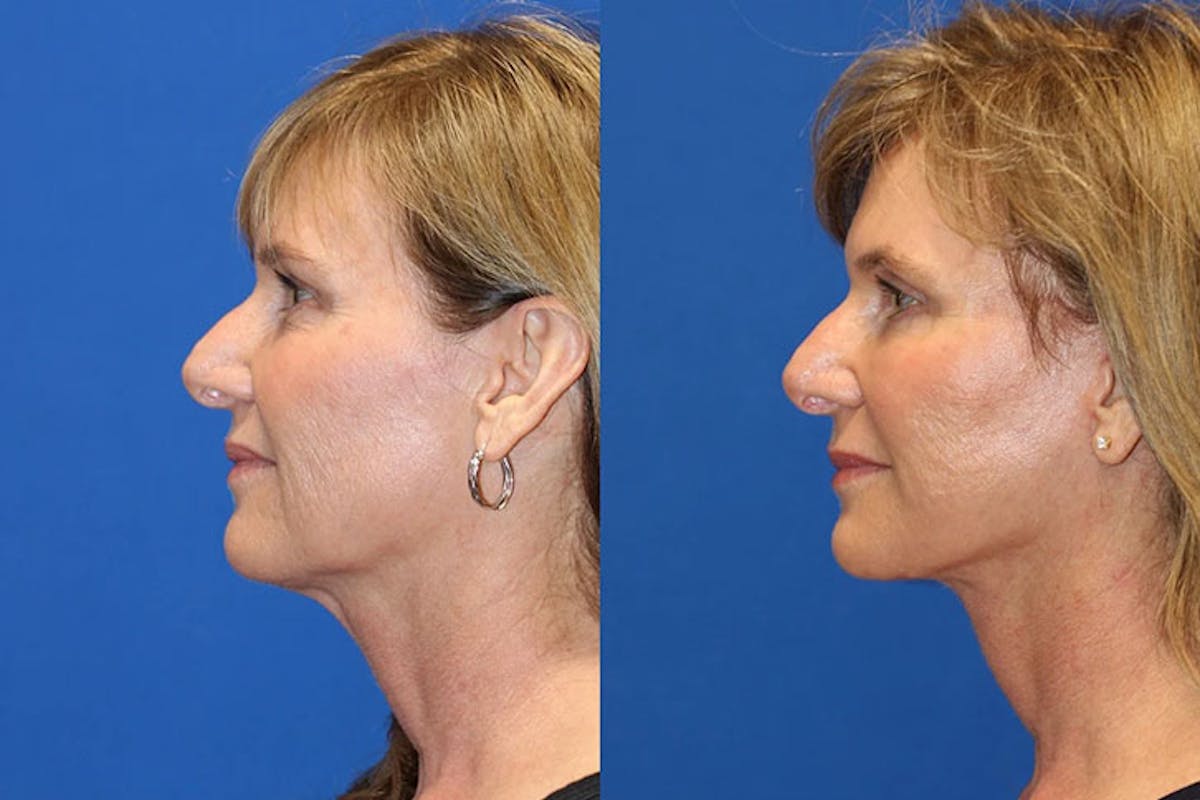 Laser Before & After Gallery - Patient 71701872 - Image 3