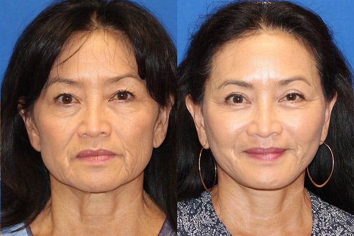 Laser Before & After Gallery - Patient 71701873 - Image 1