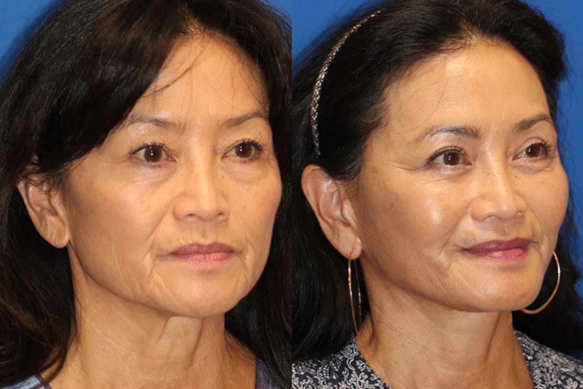 Laser Before & After Gallery - Patient 71701873 - Image 2