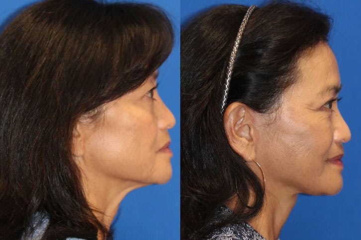 Laser Before & After Gallery - Patient 71701873 - Image 3