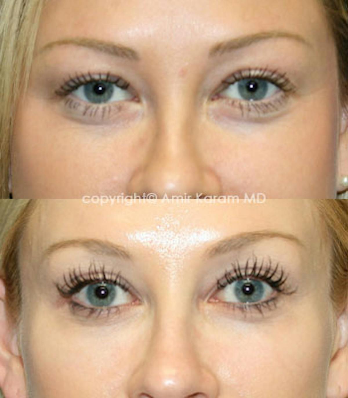 Non-Surgical Eye Rejuvenation Before & After Gallery - Patient 71701874 - Image 1