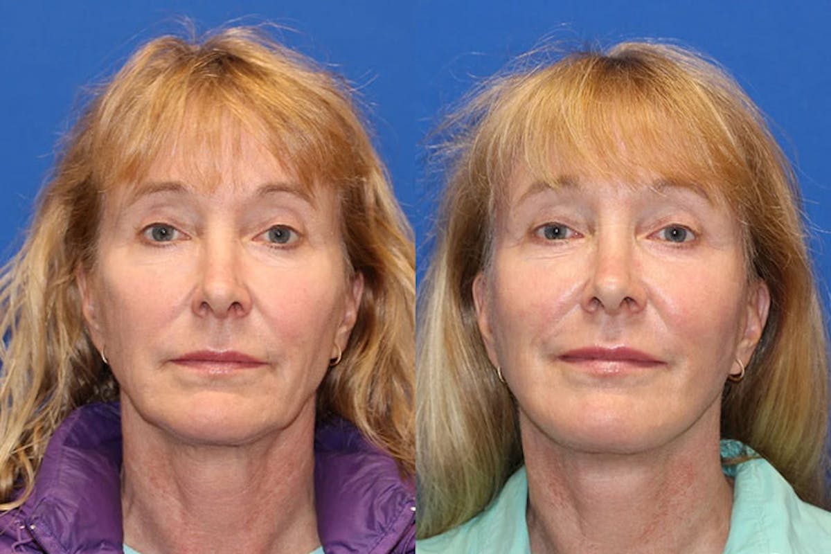 Laser Before & After Gallery - Patient 71701881 - Image 1
