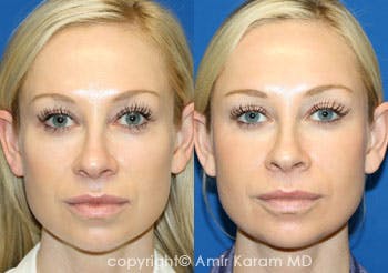 Non-Surgical Eye Rejuvenation Before & After Gallery - Patient 71701876 - Image 1