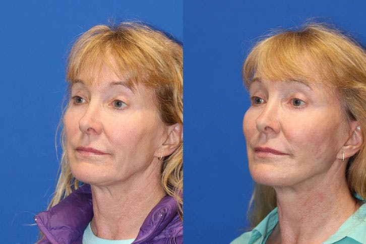 Laser Before & After Gallery - Patient 71701881 - Image 2