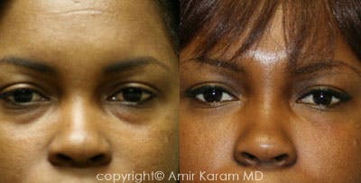 Non-Surgical Eye Rejuvenation Before & After Gallery - Patient 71701880 - Image 1