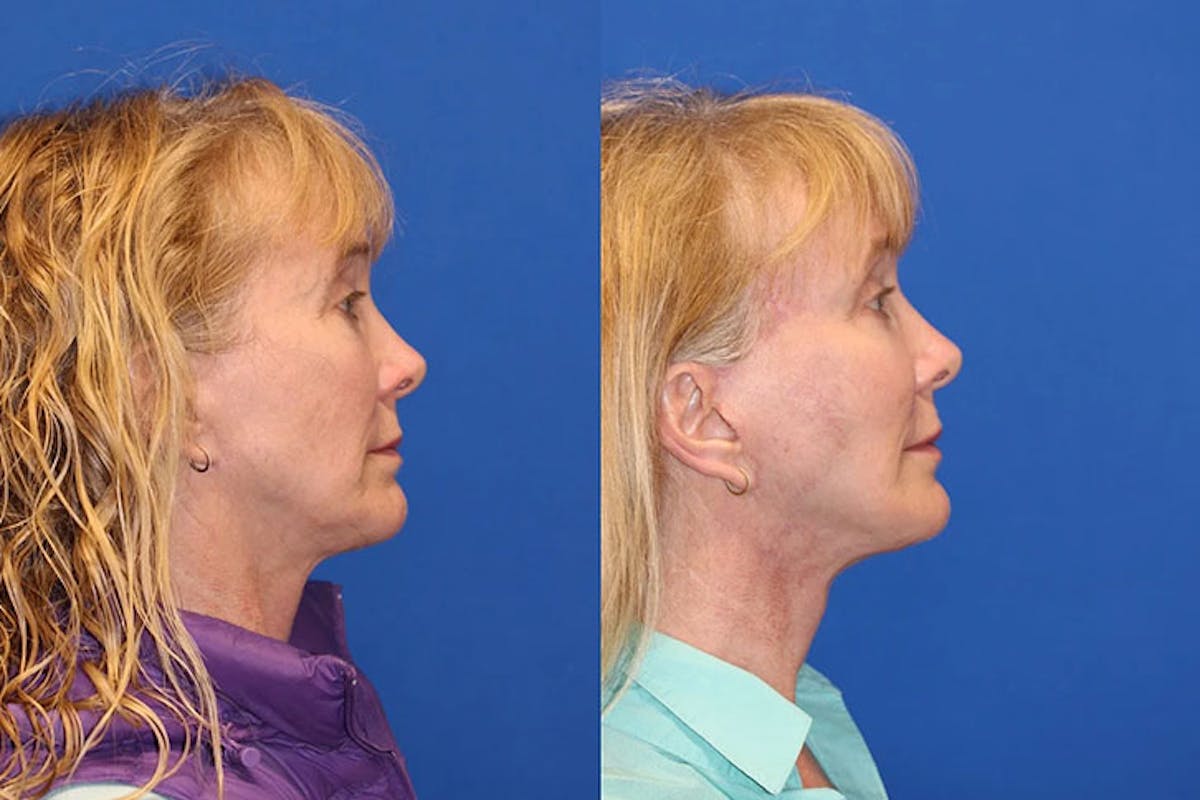 Laser Before & After Gallery - Patient 71701881 - Image 3