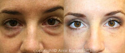 Non-Surgical Eye Rejuvenation Before & After Gallery - Patient 71701882 - Image 1