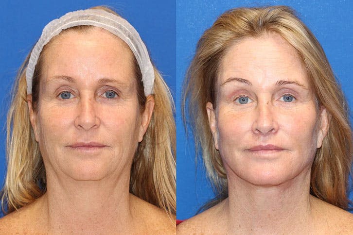 Laser Before & After Gallery - Patient 71701891 - Image 1