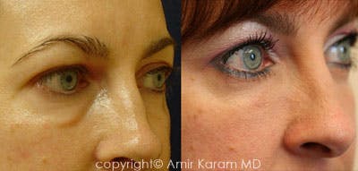 Non-Surgical Eye Rejuvenation Before & After Gallery - Patient 71701890 - Image 1