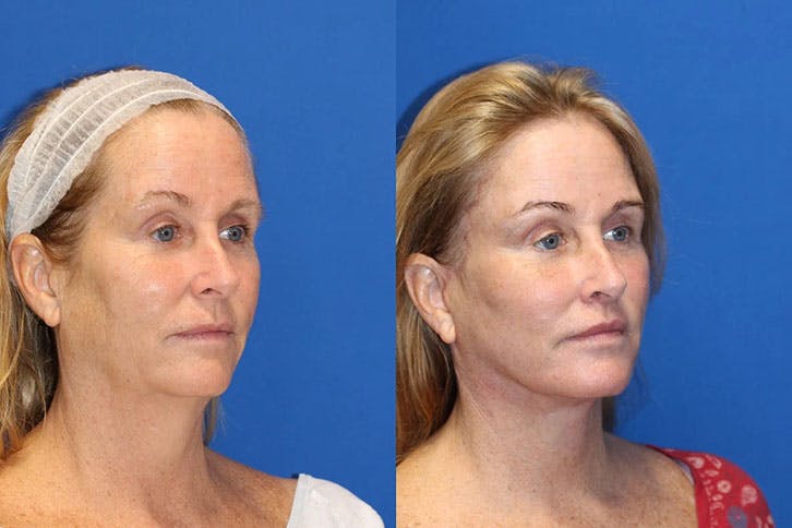 Laser Before & After Gallery - Patient 71701891 - Image 2