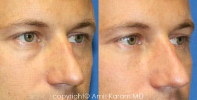 Non-Surgical Eye Rejuvenation Before & After Gallery - Patient 71701895 - Image 1