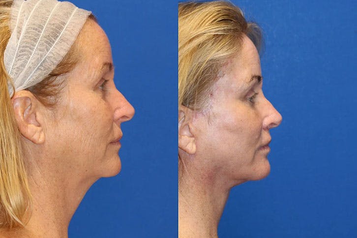 Laser Before & After Gallery - Patient 71701891 - Image 3