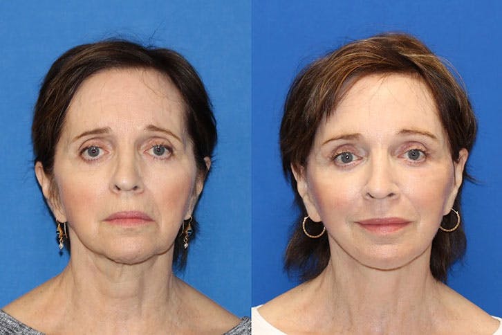 Laser Before & After Gallery - Patient 71701897 - Image 1