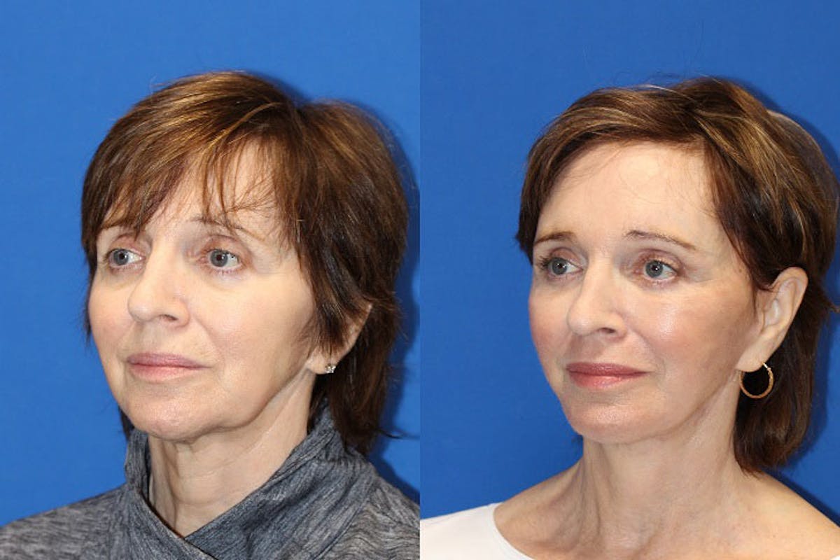 Laser Before & After Gallery - Patient 71701897 - Image 3