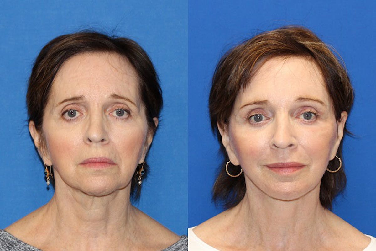 Laser Before & After Gallery - Patient 71701897 - Image 4