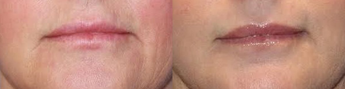 Laser Before & After Gallery - Patient 71701903 - Image 1