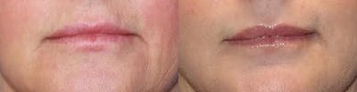 Laser Before & After Gallery - Patient 71701903 - Image 1