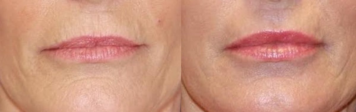 Laser Before & After Gallery - Patient 71701904 - Image 1