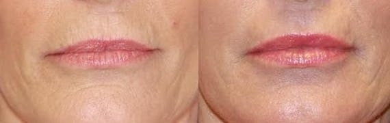 Laser Before & After Gallery - Patient 71701904 - Image 1
