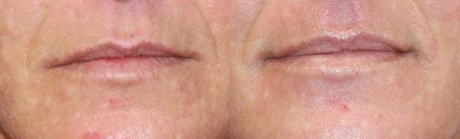 Laser Before & After Gallery - Patient 71701906 - Image 1