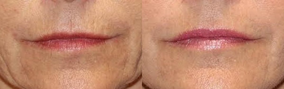 Laser Before & After Gallery - Patient 71701909 - Image 1