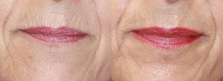 Laser Before & After Gallery - Patient 71701911 - Image 1