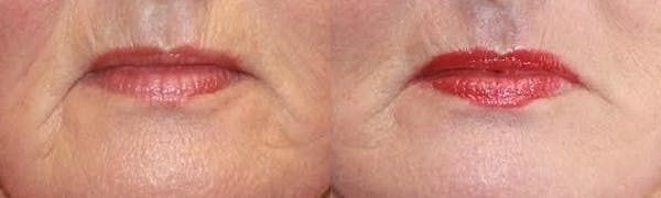 Laser Before & After Gallery - Patient 71701912 - Image 1