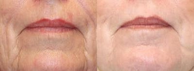 Laser Before & After Gallery - Patient 71701913 - Image 1