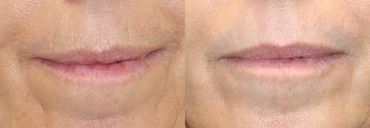 Laser Before & After Gallery - Patient 71701914 - Image 1