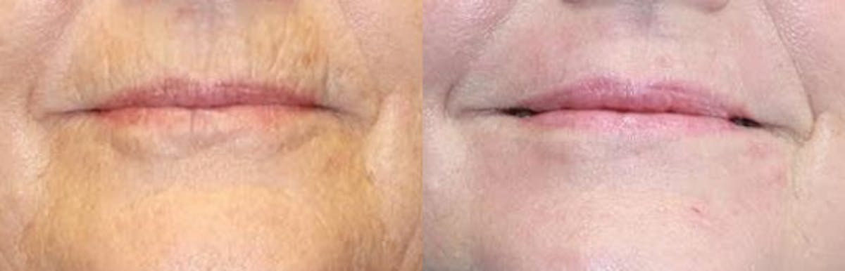 Laser Before & After Gallery - Patient 71701916 - Image 1
