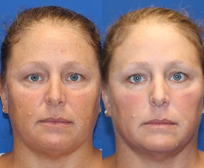 Laser Before & After Gallery - Patient 71701932 - Image 1
