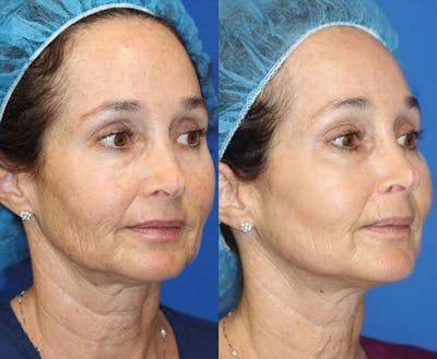 Laser Before & After Gallery - Patient 71701933 - Image 1