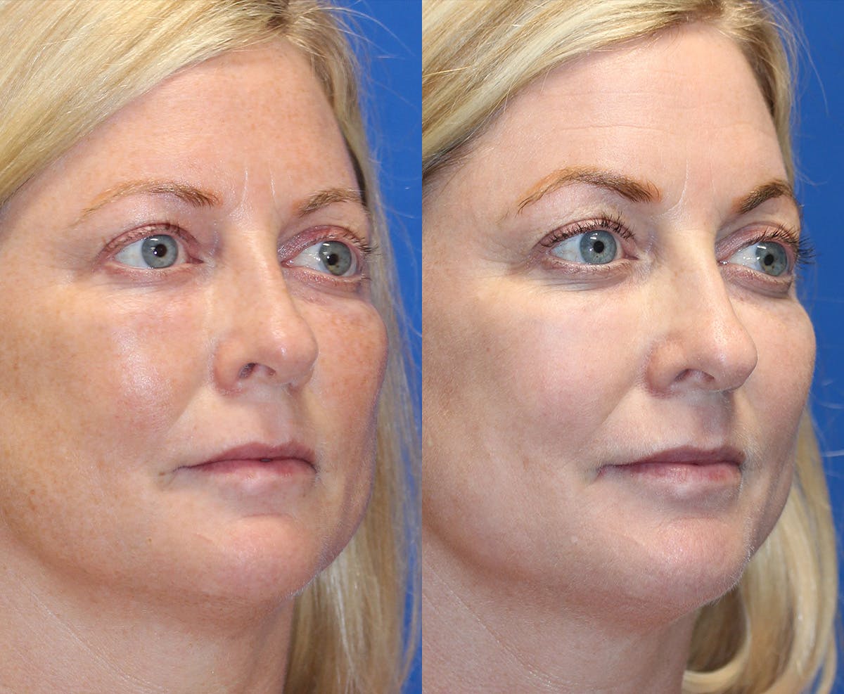 Laser Before & After Gallery - Patient 71701934 - Image 1