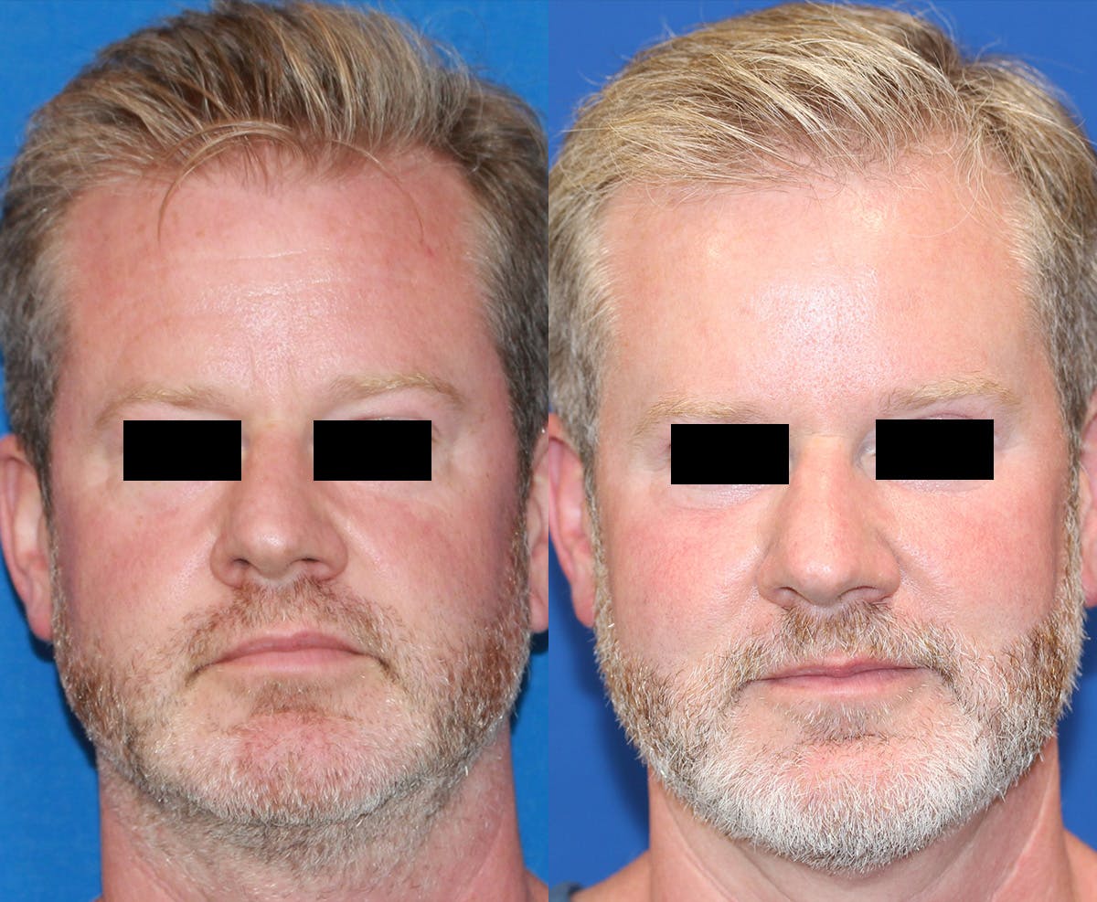 Laser Before & After Gallery - Patient 71701946 - Image 1