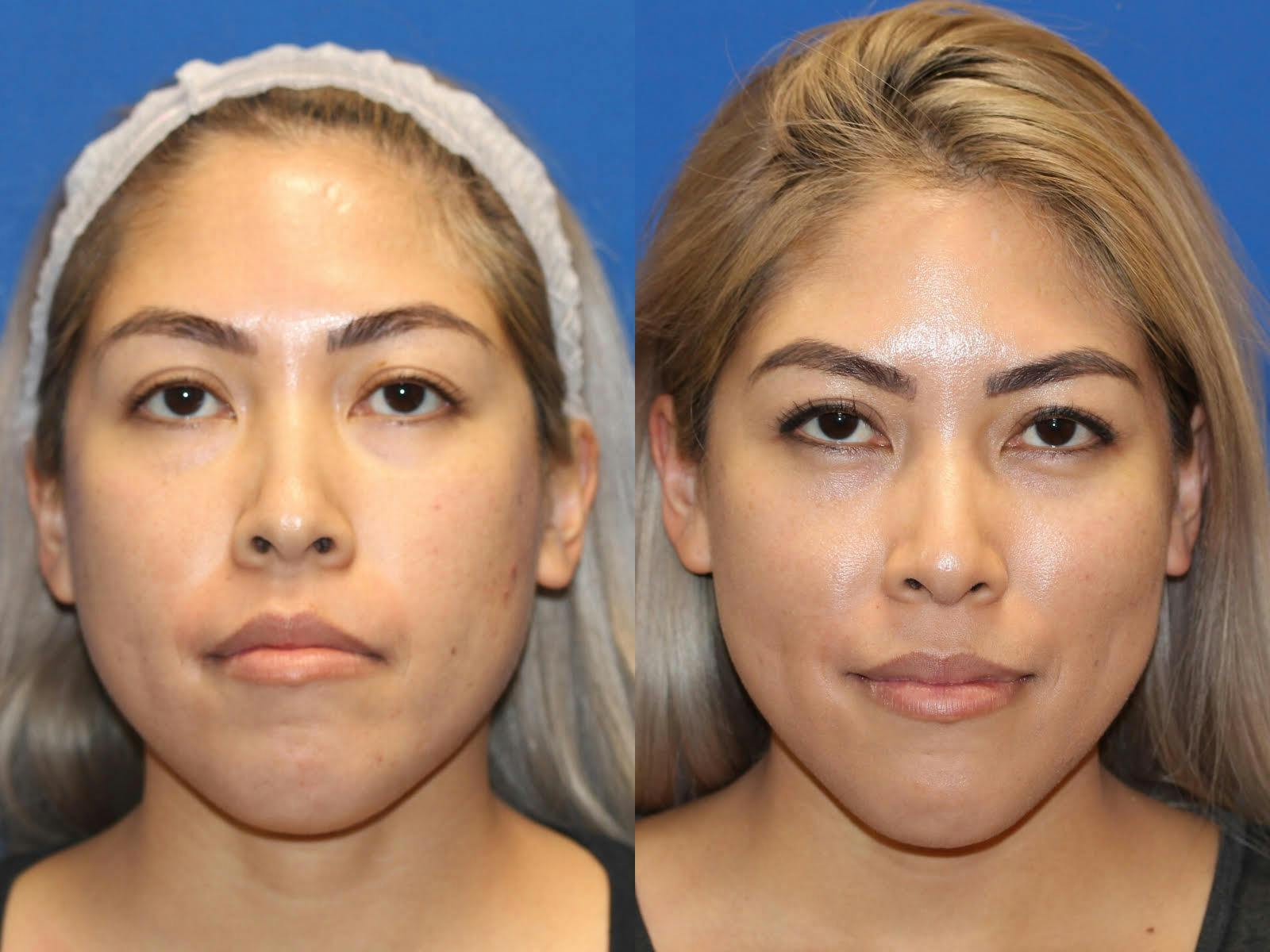 Laser Before & After Gallery - Patient 71701951 - Image 1