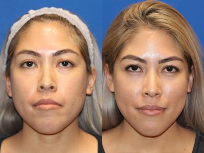 Laser Before & After Gallery - Patient 71701951 - Image 1