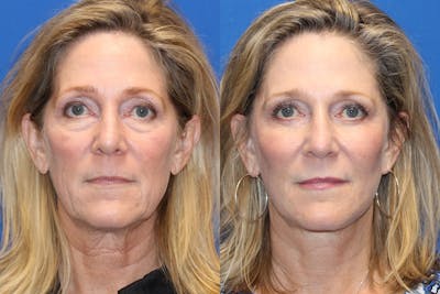Laser Before & After Gallery - Patient 71701963 - Image 1