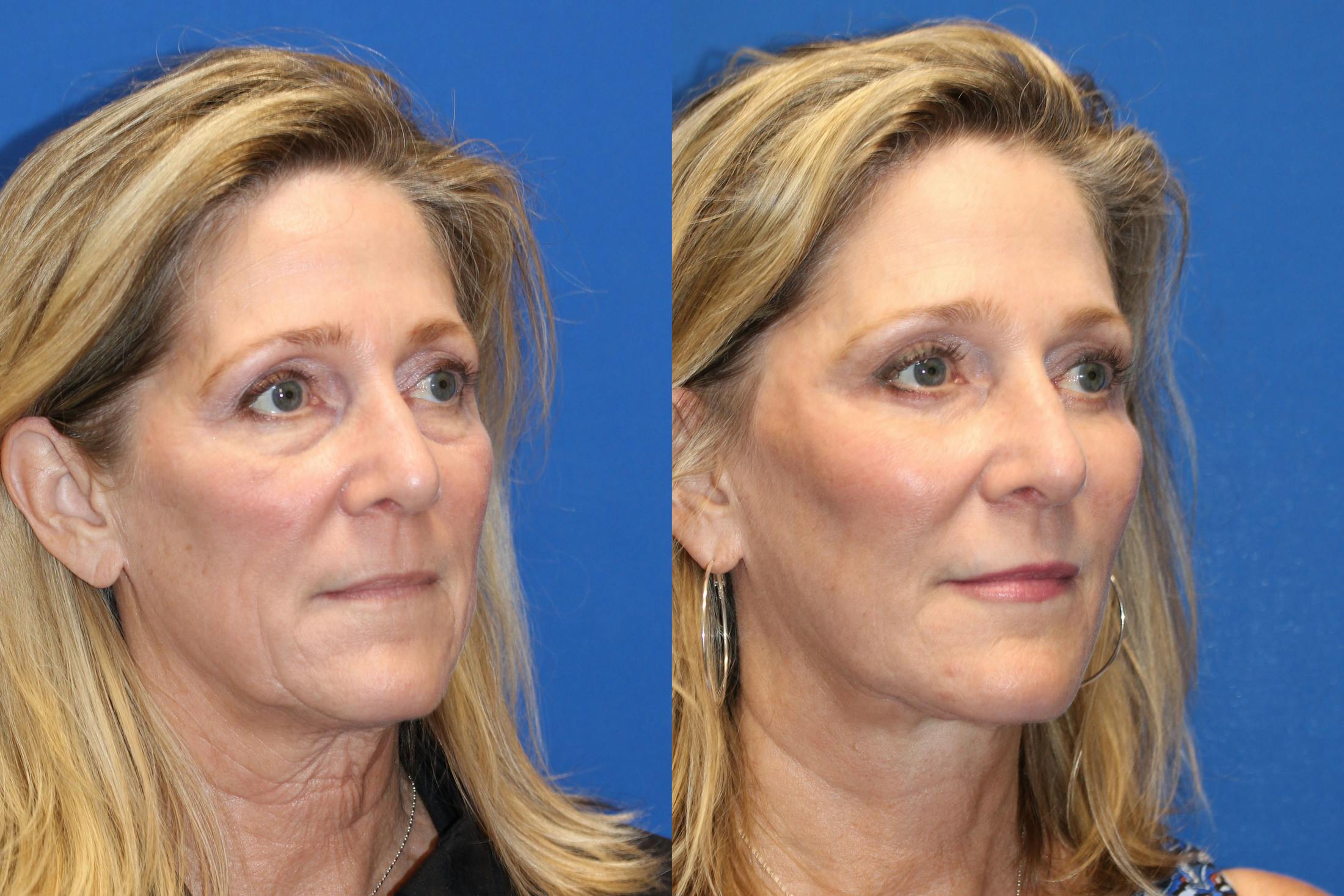 Laser Before & After Gallery - Patient 71701963 - Image 2