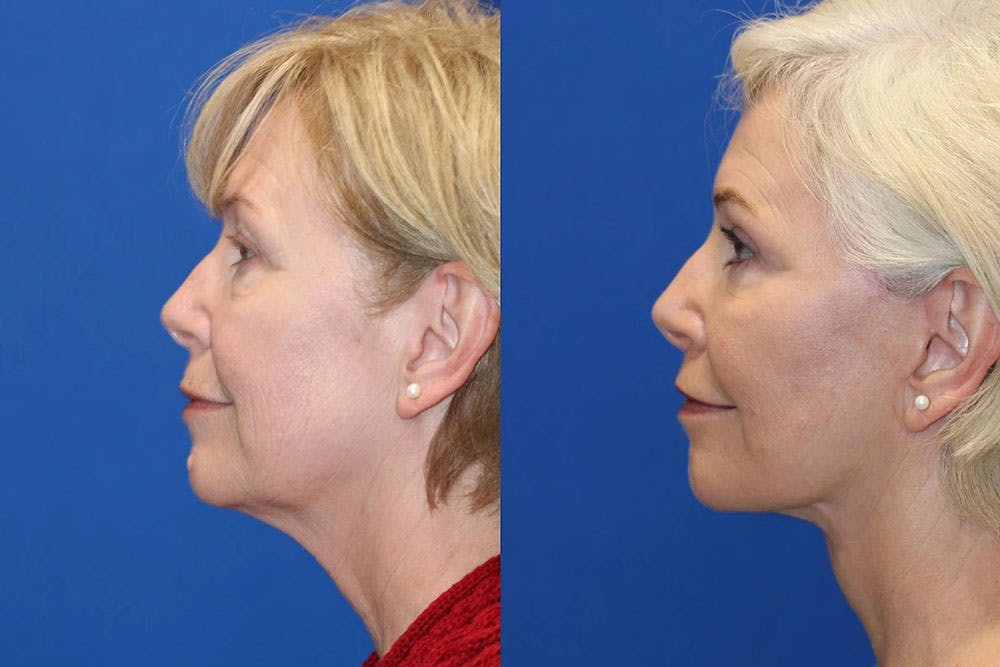 Laser Before & After Gallery - Patient 71701973 - Image 4