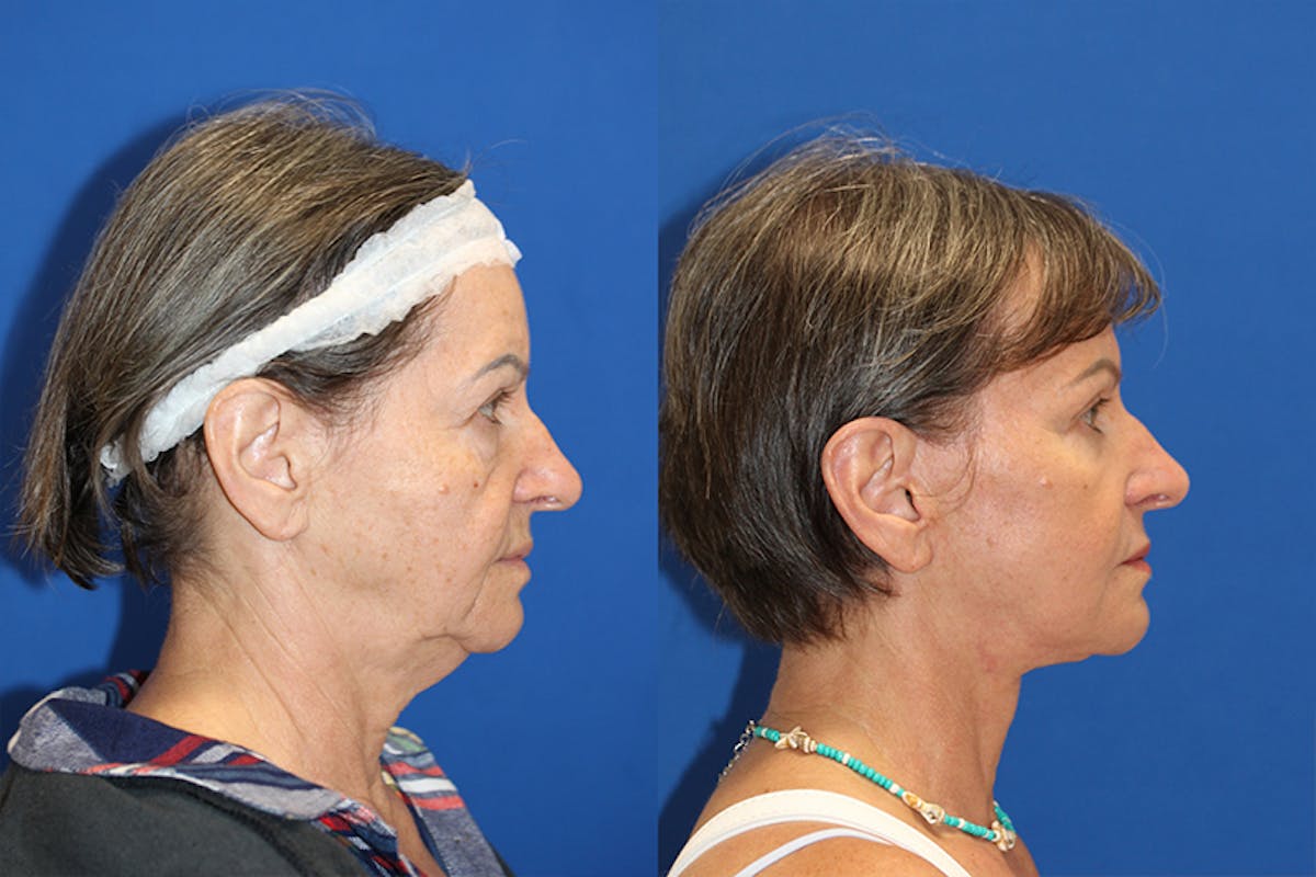 Laser Before & After Gallery - Patient 71701985 - Image 2