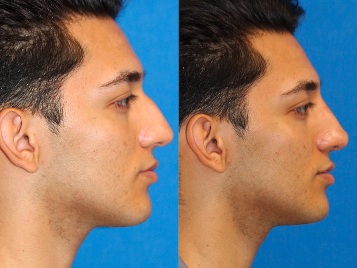 Non-Surgical Rhinoplasty Before & After Gallery - Patient 71702268 - Image 1