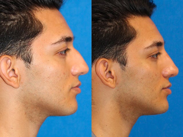 Non-Surgical Rhinoplasty Gallery - Patient 71702268 - Image 1