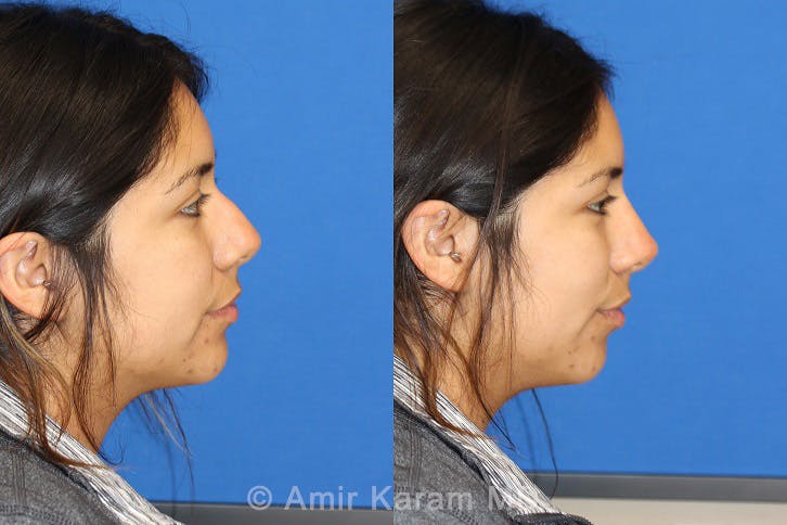 Non-Surgical Rhinoplasty