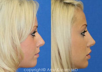 Non-Surgical Rhinoplasty Before & After Gallery - Patient 71702272 - Image 1