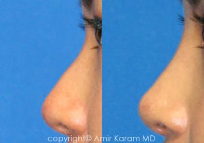 Non-Surgical Rhinoplasty Before & After Gallery - Patient 71702273 - Image 1