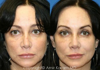 Non-Surgical Rhinoplasty Before & After Gallery - Patient 71702274 - Image 1