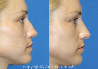 Non-Surgical Rhinoplasty Before & After Gallery - Patient 71702275 - Image 1