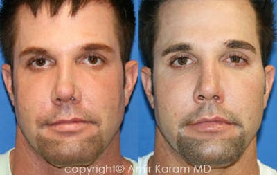 Non-Surgical Rhinoplasty Before & After Gallery - Patient 71702276 - Image 1