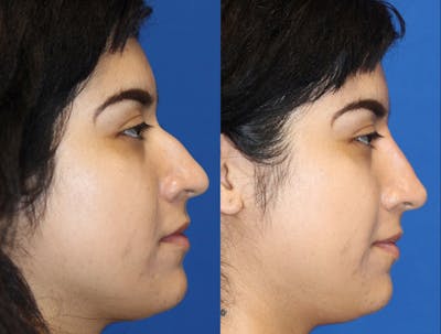 Non-Surgical Rhinoplasty Before & After Gallery - Patient 71702277 - Image 1